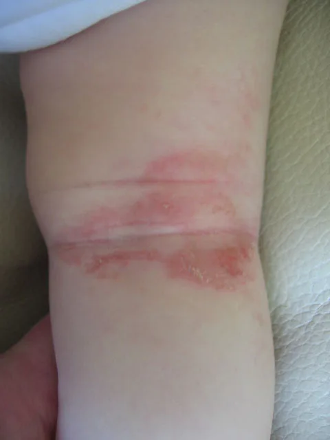 Alergia à proteína do leite